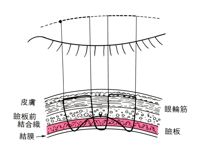 二重まぶた 二重 埋没法