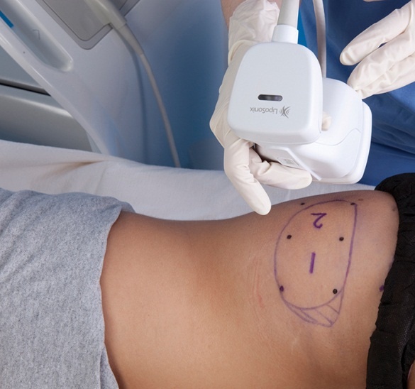 ライポソニックス